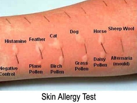 allergy tests?